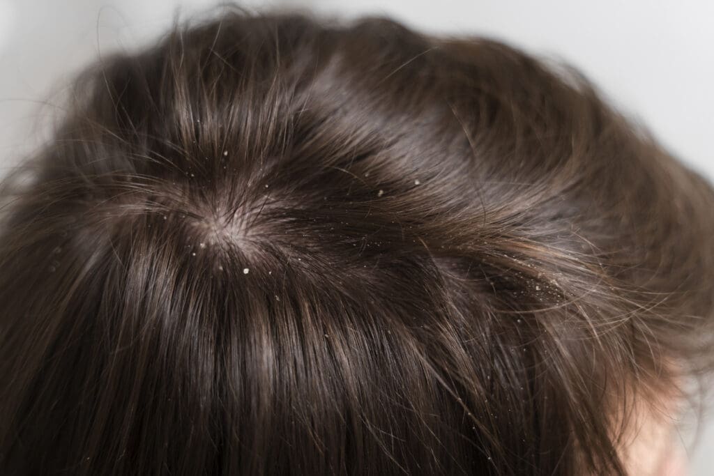 close up hair with dandruff